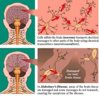 alzheimers-disease.jpg